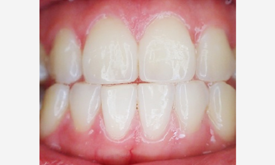 Gesunde Zähne und gesundes Zahnfleisch ohne Zahnfleischrückgang
