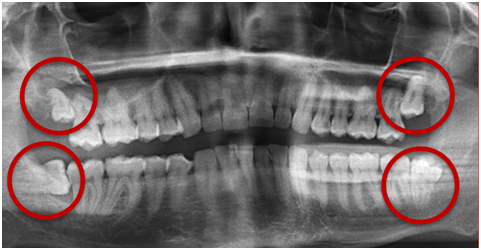 Panorama Röntgen mit vier retinierten Weisheitszähnen