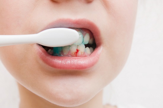 Blutendes Zahnfleisch bei einem Kind