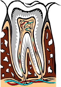 Tooth root inflammation calls for a root canal treatment