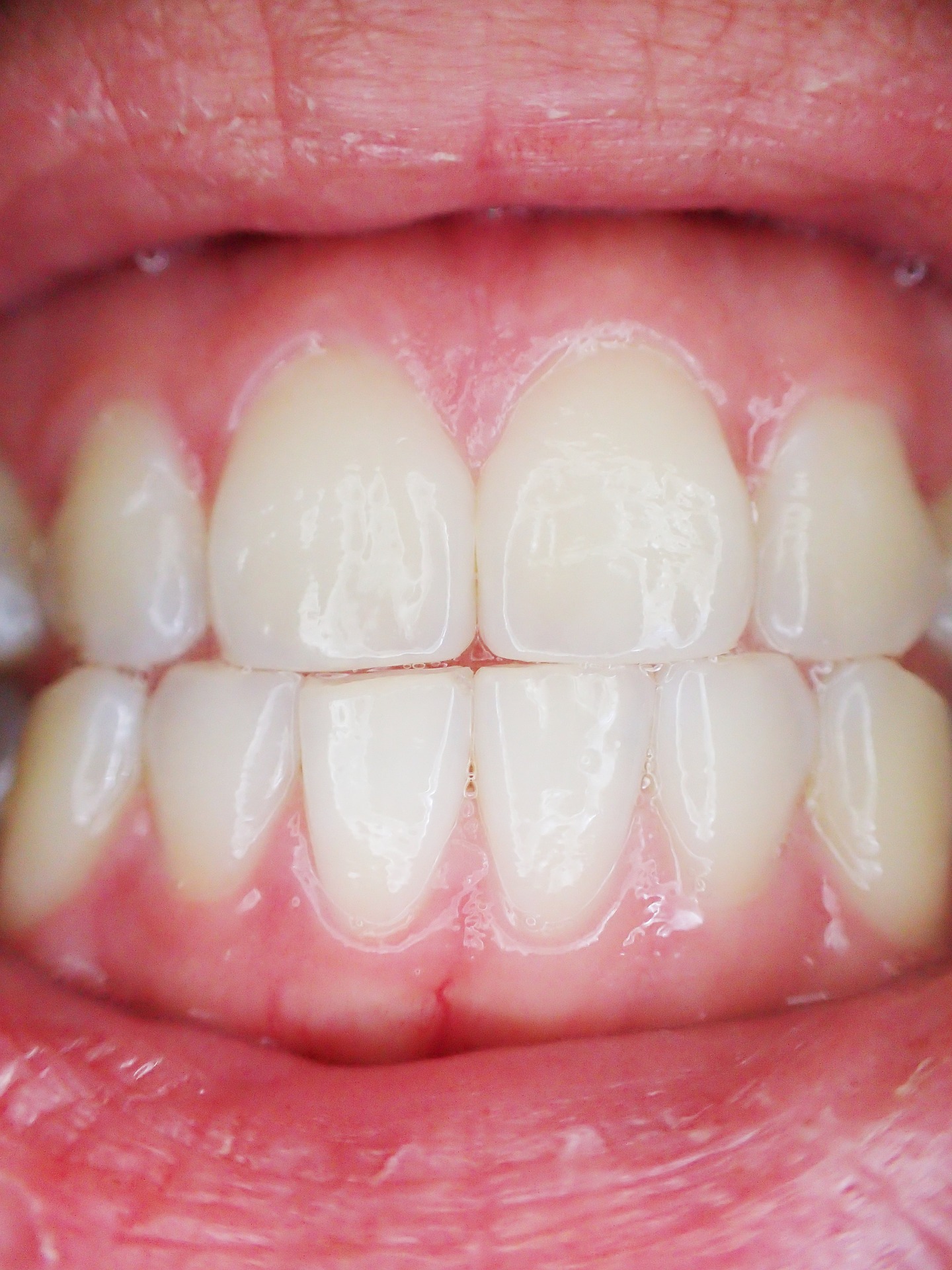 Healthy gums without bleeding