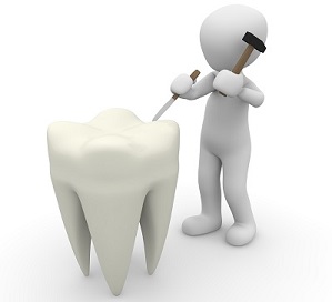 Dental enamel under attack by tooth decay
