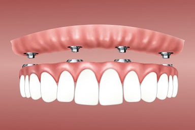 Dental implant covering the entire  upper jaw