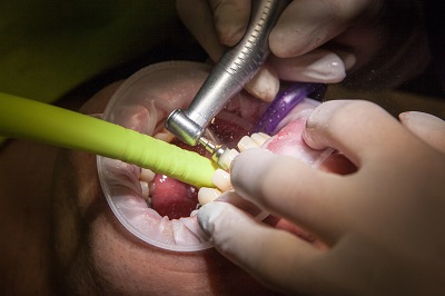 Dentist places a dental crown