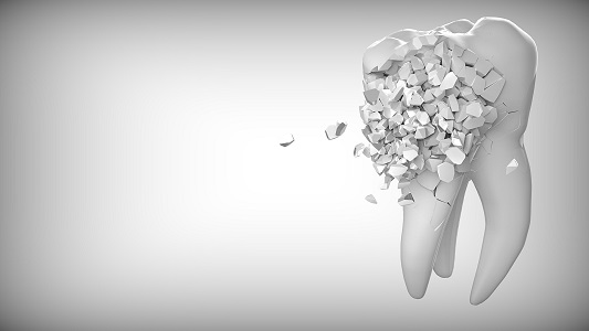 Ein zerbrochener Zahn muss durch ein Zahnimplantat ersetzt werden