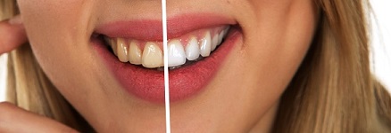 Ein gesundes Lächeln vor und nach einer Zahnaufhellung
