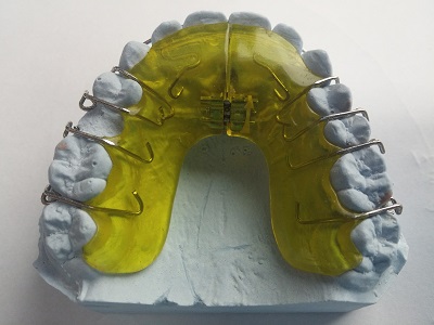 Zahnspange Oberkiefer