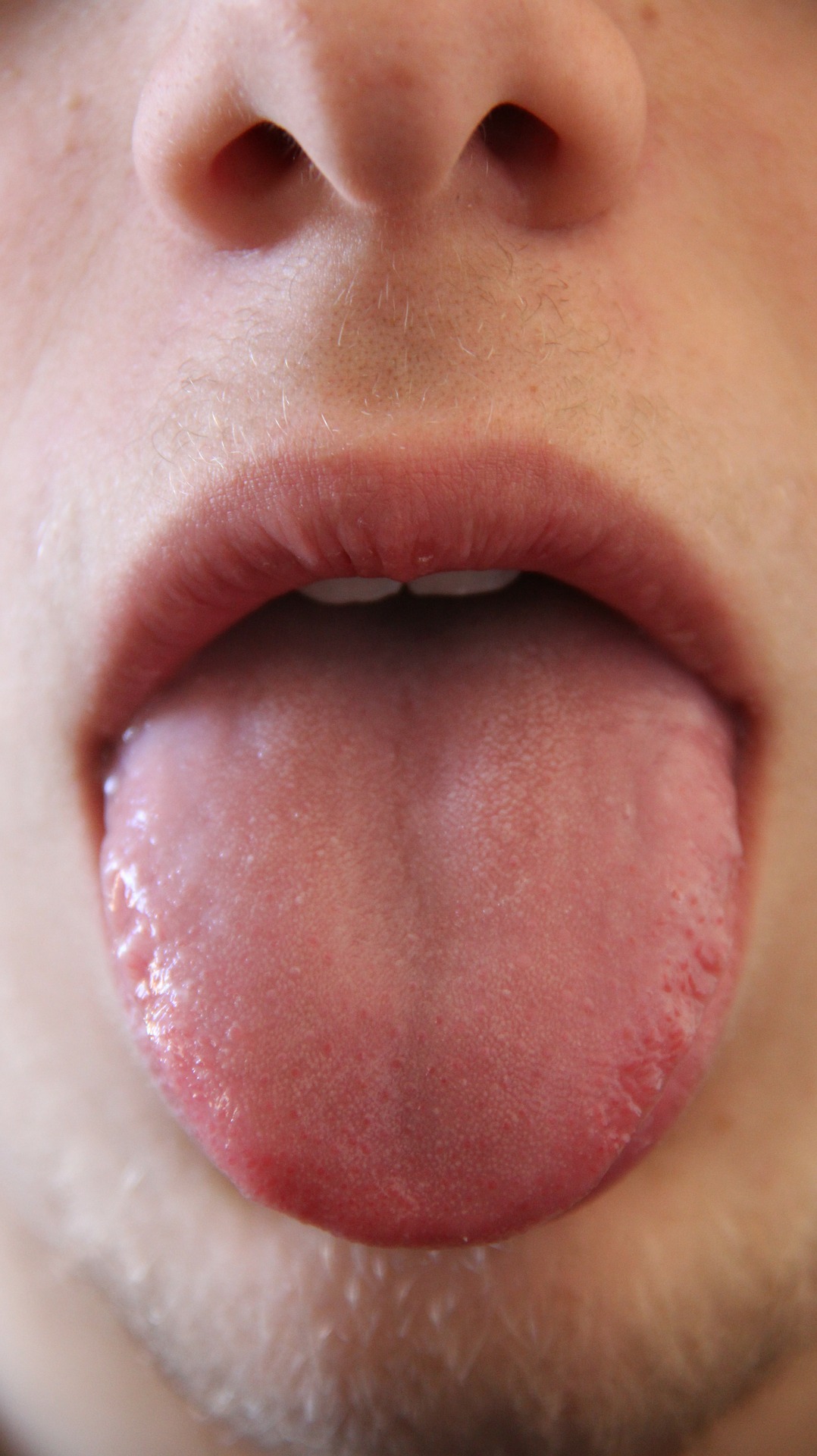 Tongue damage after excessive energy drink consumption