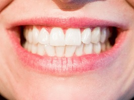 Perfectly aligned teeth thanks to braces