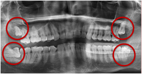 Four impacted wisdom teeth