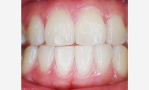 Zahnfleischlifting bei Zahnfleischrückgang