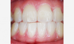 Gum lifting to combat gum recession