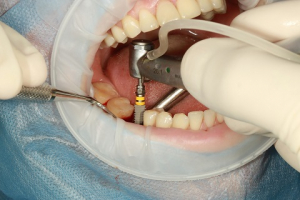 Zahnarzt bei der Implantation eines Implantats