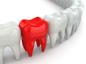 Are amalgam tooth fillings dangerous?
