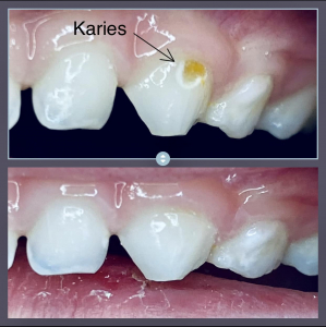 Kariesbehandlung bei Kinder